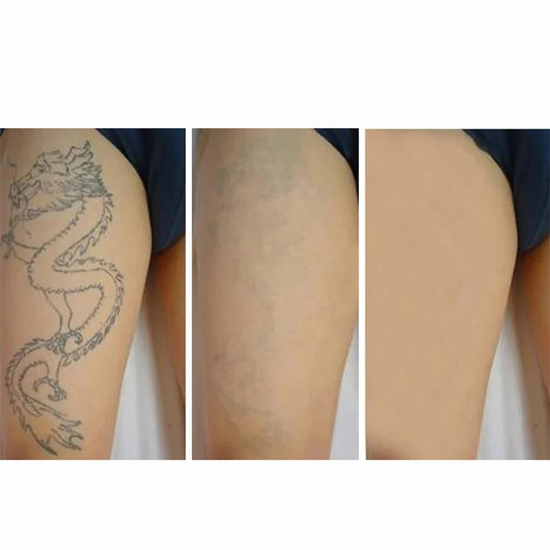 Laser Skin Whitening Tattoo Removal Machine