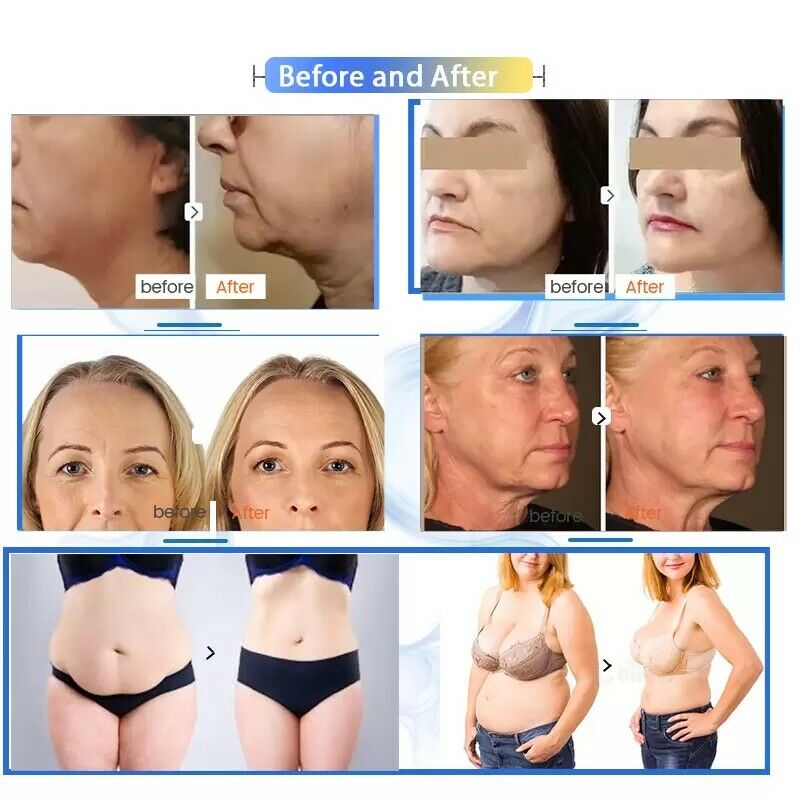 7D Hifu Machine Wrinkle Removal Body Face Lifting Skin Tightening 7 Cartridges